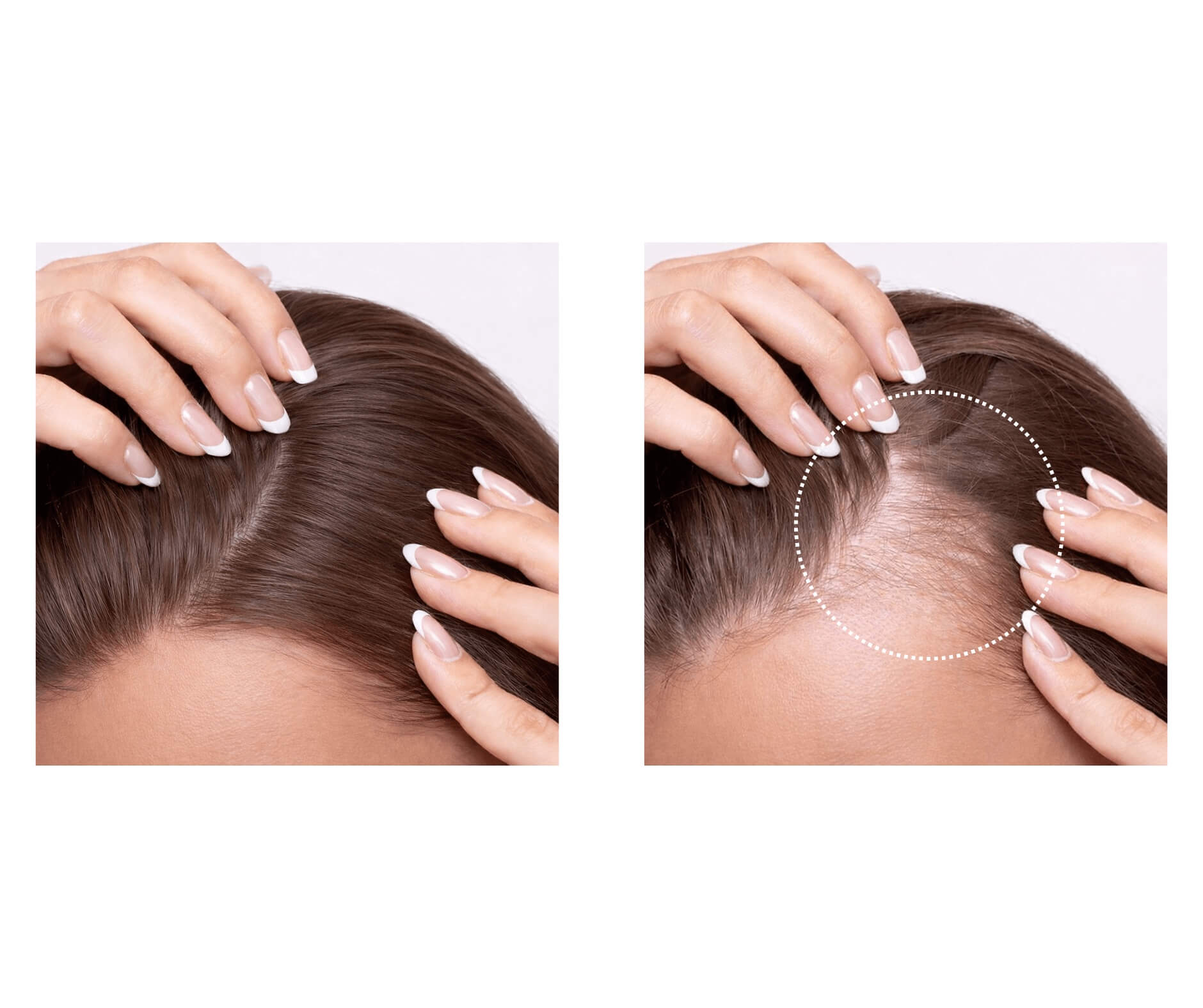 Illustrasjon som viser forskjell på normalt hår og tynnere hår med redusert hårvekst.